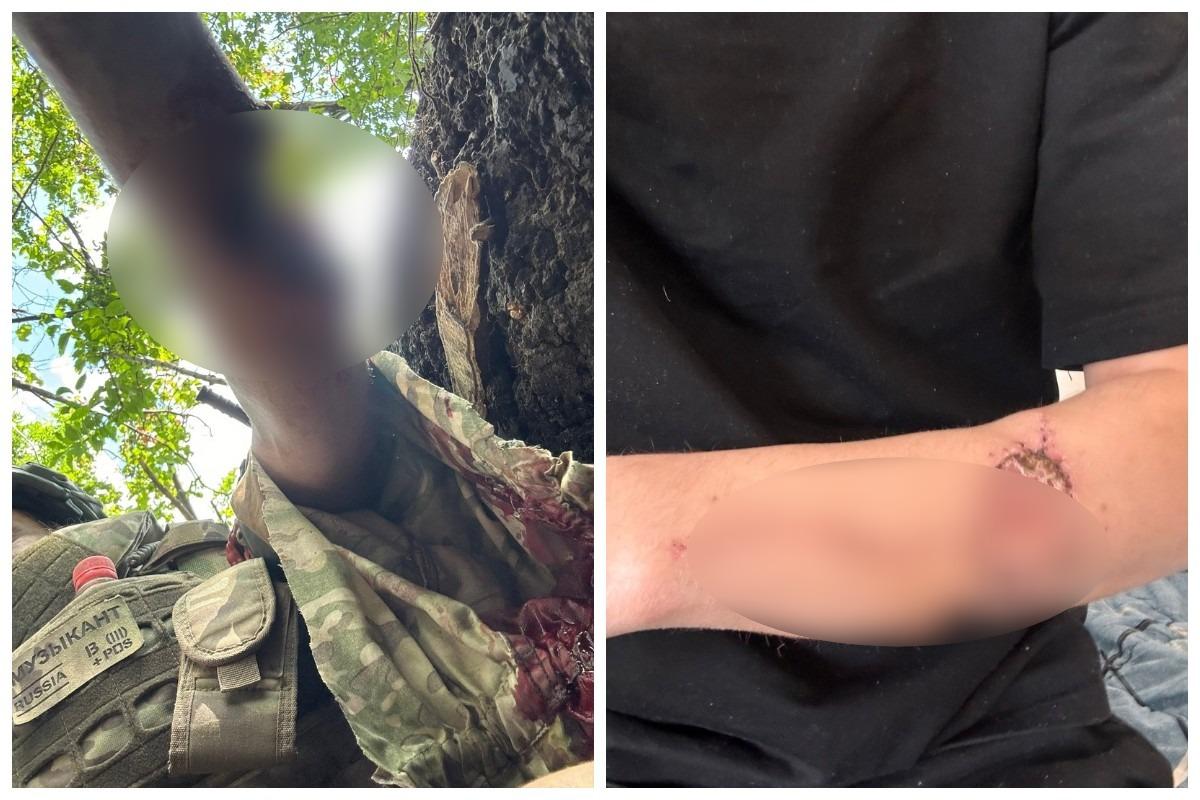 Фото «Кусок с живота пересадили в руку». Доброволец СВО пережил уникальную операцию в Новосибирске 2